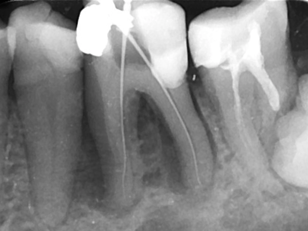 Koreninsko zdravljenje - klinični primer C