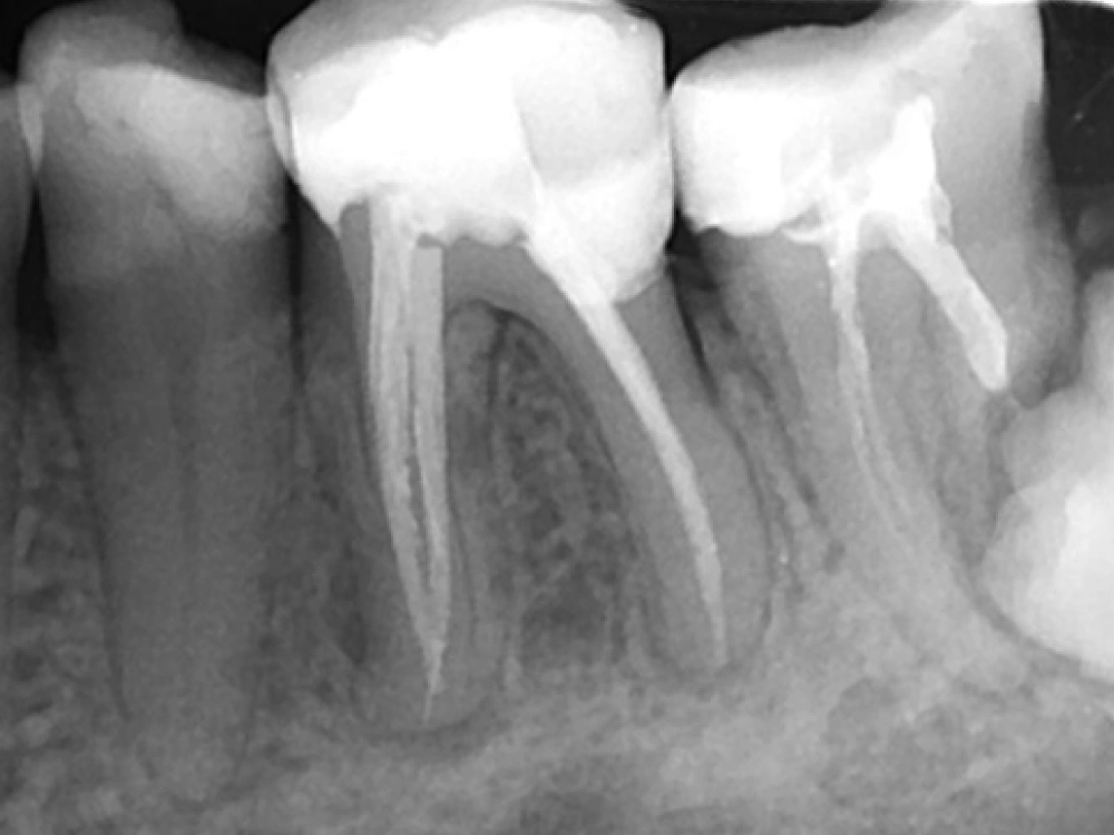 Koreninsko zdravljenje - klinični primer C
