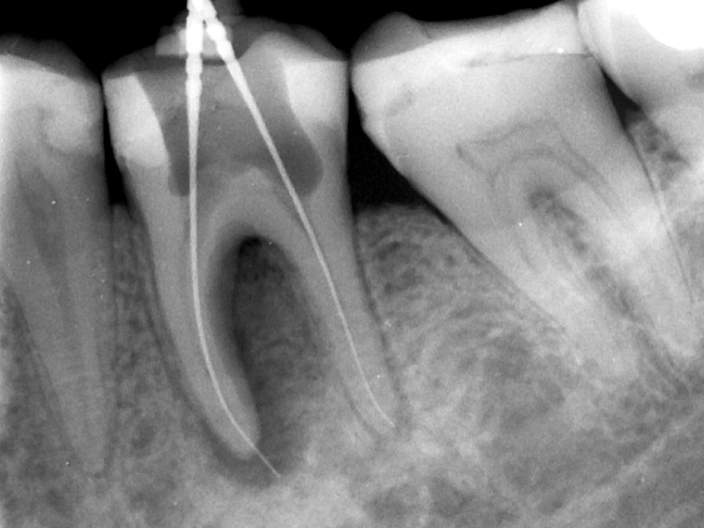 Koreninsko zdravljenje - klinični primer E