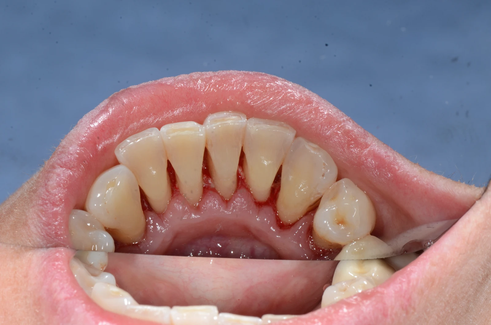 Čiščenje zobnega kamna potem