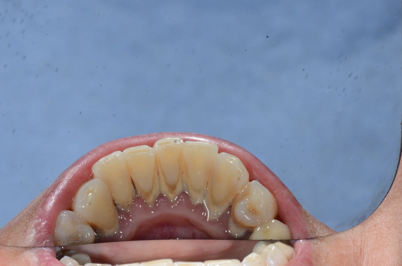 Čiščenje zobnega kamna prej