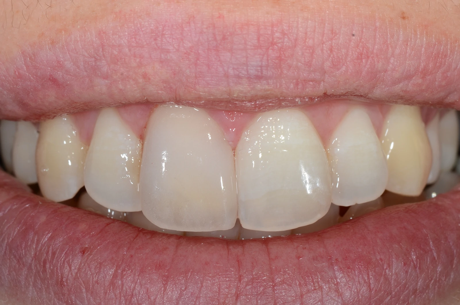 Estetsko zobozdravstvo - venir