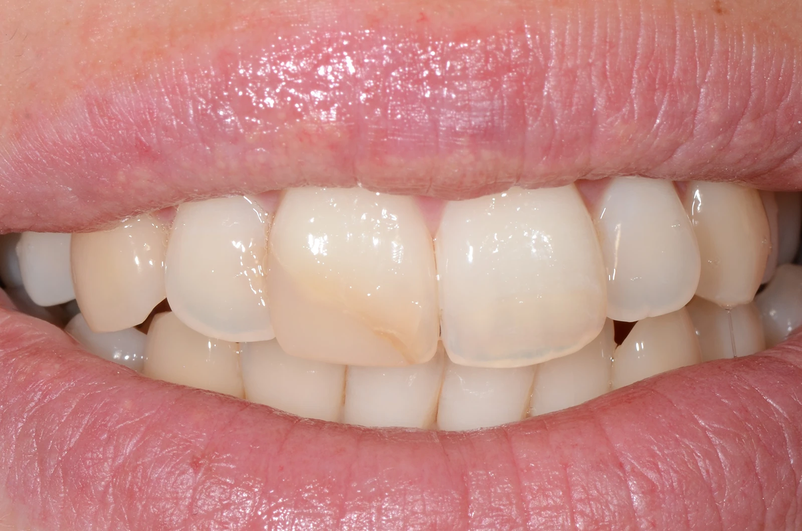 Estetsko zobozdravstvo - venir