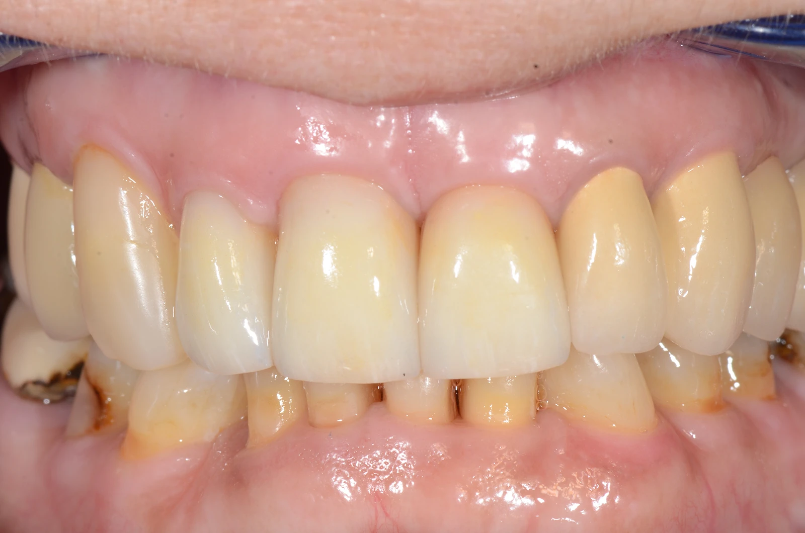 Estetsko zobozdravstvo - venir