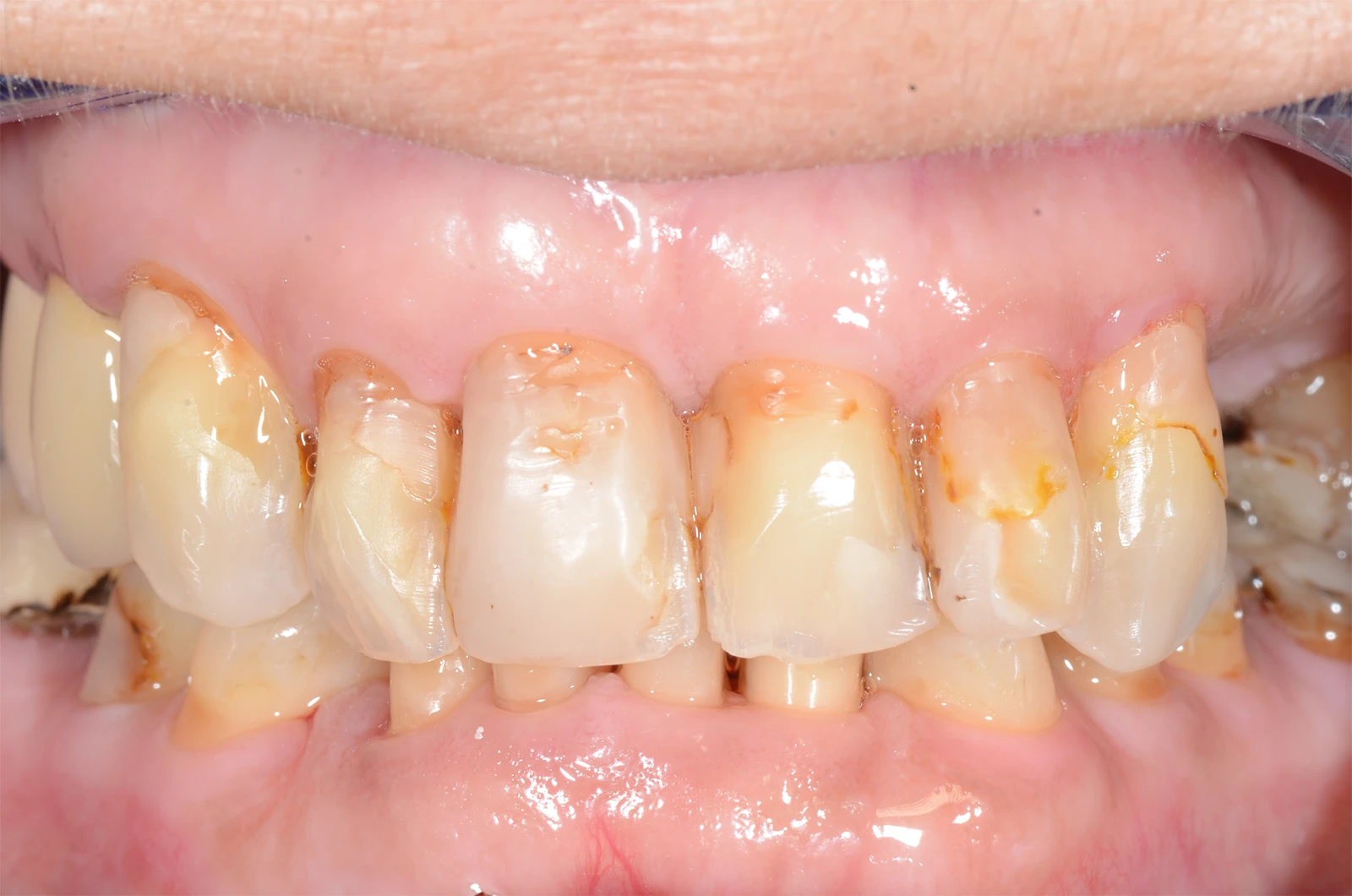 Estetsko zobozdravstvo - venir