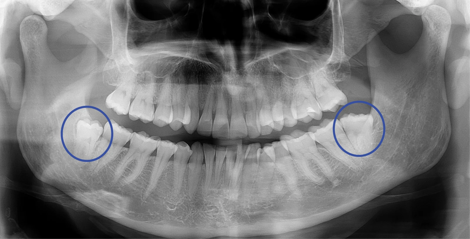 Oralna kirurgija prej