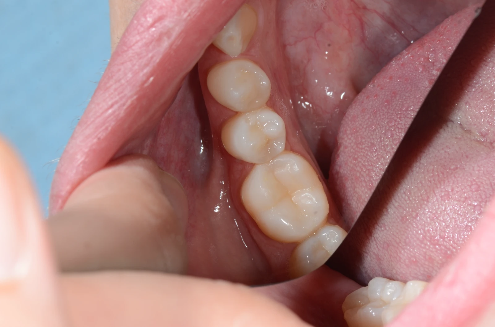 Zalivke / plombe potem