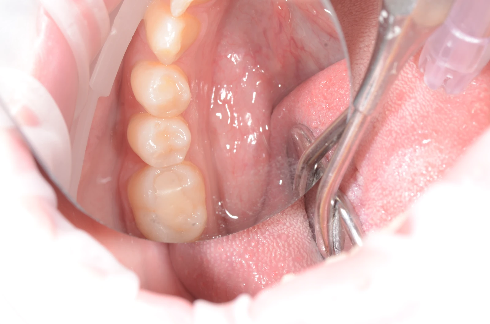 Zalivke / plombe prej